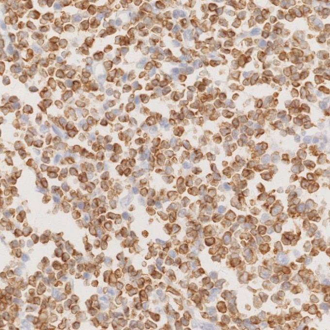 Immunohistochemistry (IHC) staining of human lymphoma tissue using BCL2 Monoclonal antibody (60178-1-Ig)