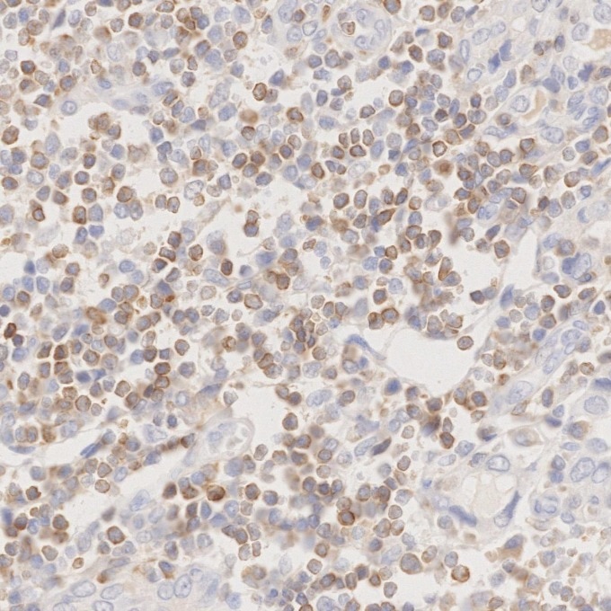 Immunohistochemistry (IHC) staining of human lymphoma tissue using BCL2 Monoclonal antibody (60178-1-Ig)