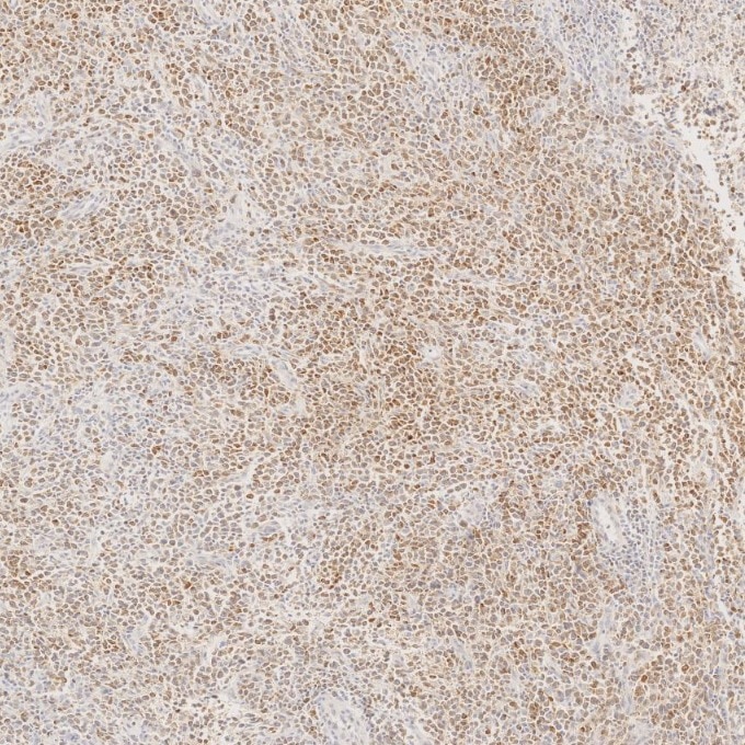 Immunohistochemistry (IHC) staining of human lymphoma tissue using BCL2 Monoclonal antibody (60178-1-Ig)