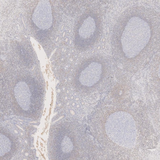 Immunohistochemistry (IHC) staining of human appendicitis tissue using BCL2 Monoclonal antibody (60178-1-Ig)