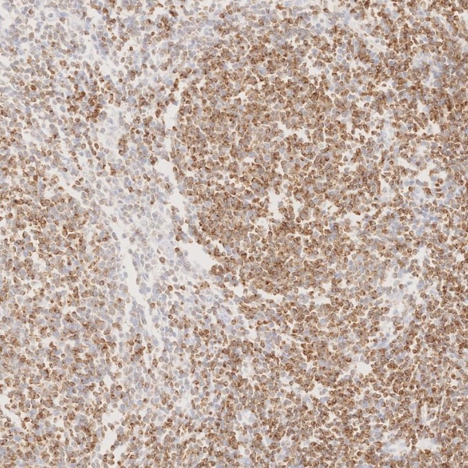 Immunohistochemistry (IHC) staining of human lymphoma tissue using BCL2 Monoclonal antibody (60178-1-Ig)