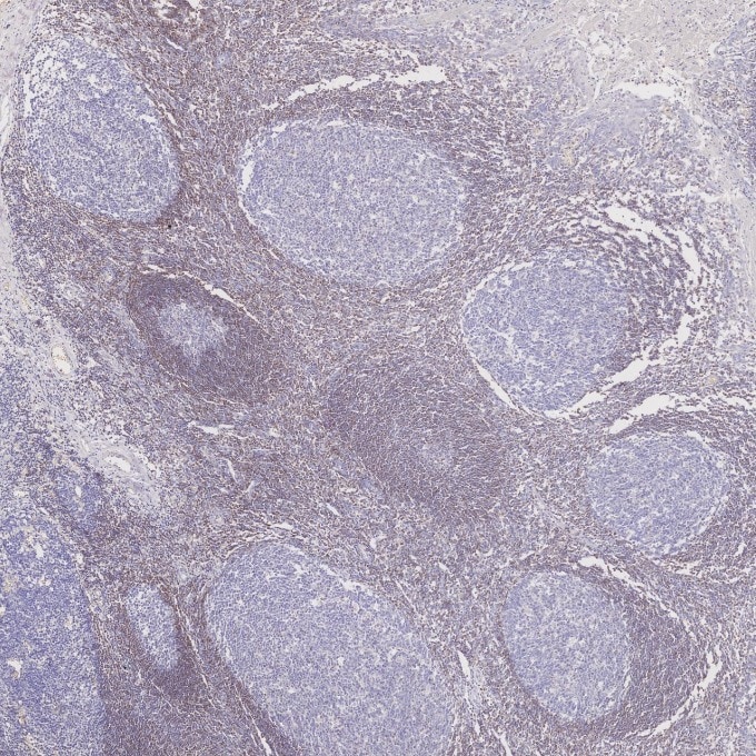 Immunohistochemistry (IHC) staining of human tonsillitis tissue using BCL2 Monoclonal antibody (60178-1-Ig)