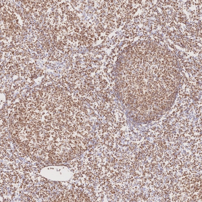 Immunohistochemistry (IHC) staining of human lymphoma tissue using BCL2 Monoclonal antibody (60178-1-Ig)