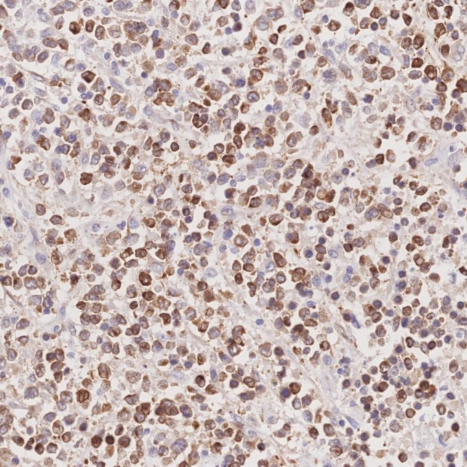 Immunohistochemistry (IHC) staining of human lymphoma tissue using BCL2 Monoclonal antibody (60178-1-Ig)