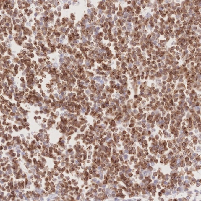 Immunohistochemistry (IHC) staining of human lymphoma tissue using BCL2 Monoclonal antibody (60178-1-Ig)