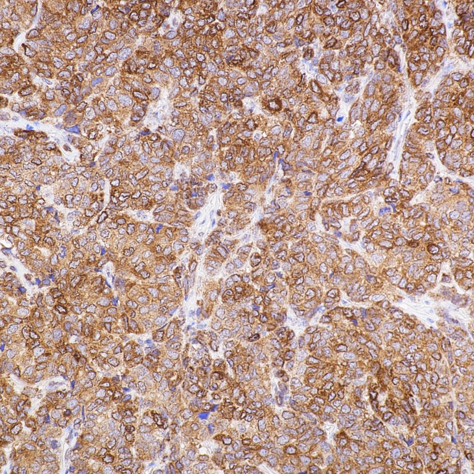 Immunohistochemistry (IHC) staining of human breast cancer tissue using BCL2 Recombinant monoclonal antibody (80313-1-RR)