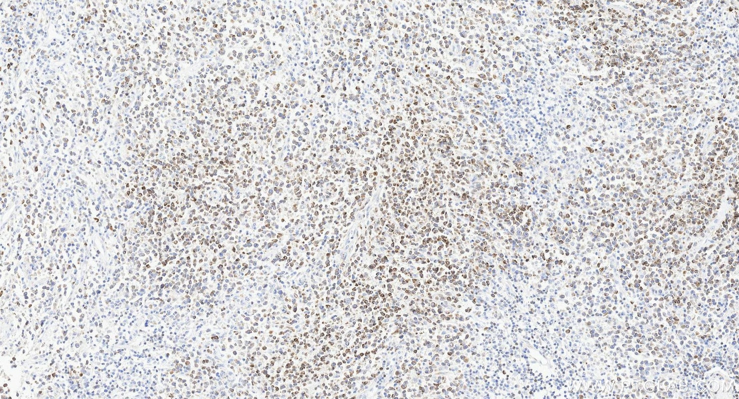 Immunohistochemistry (IHC) staining of human lymphoma tissue using BCL2 Recombinant monoclonal antibody (80313-1-RR)