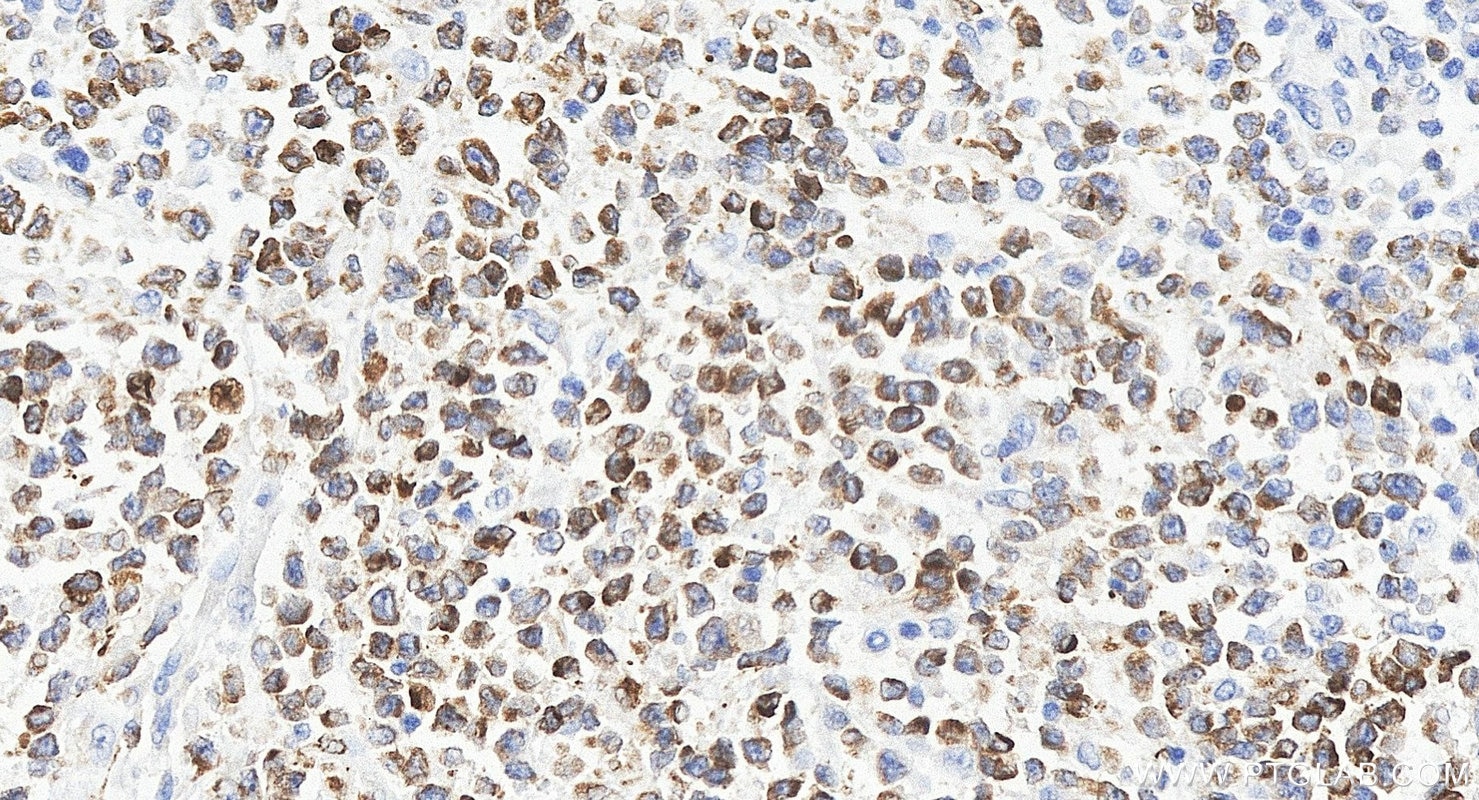 Immunohistochemistry (IHC) staining of human lymphoma tissue using BCL2 Recombinant monoclonal antibody (80313-1-RR)