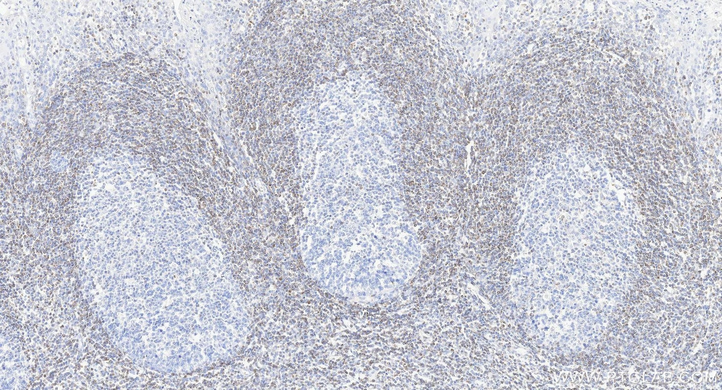 Immunohistochemistry (IHC) staining of human tonsillitis tissue using BCL2 Recombinant monoclonal antibody (80313-1-RR)