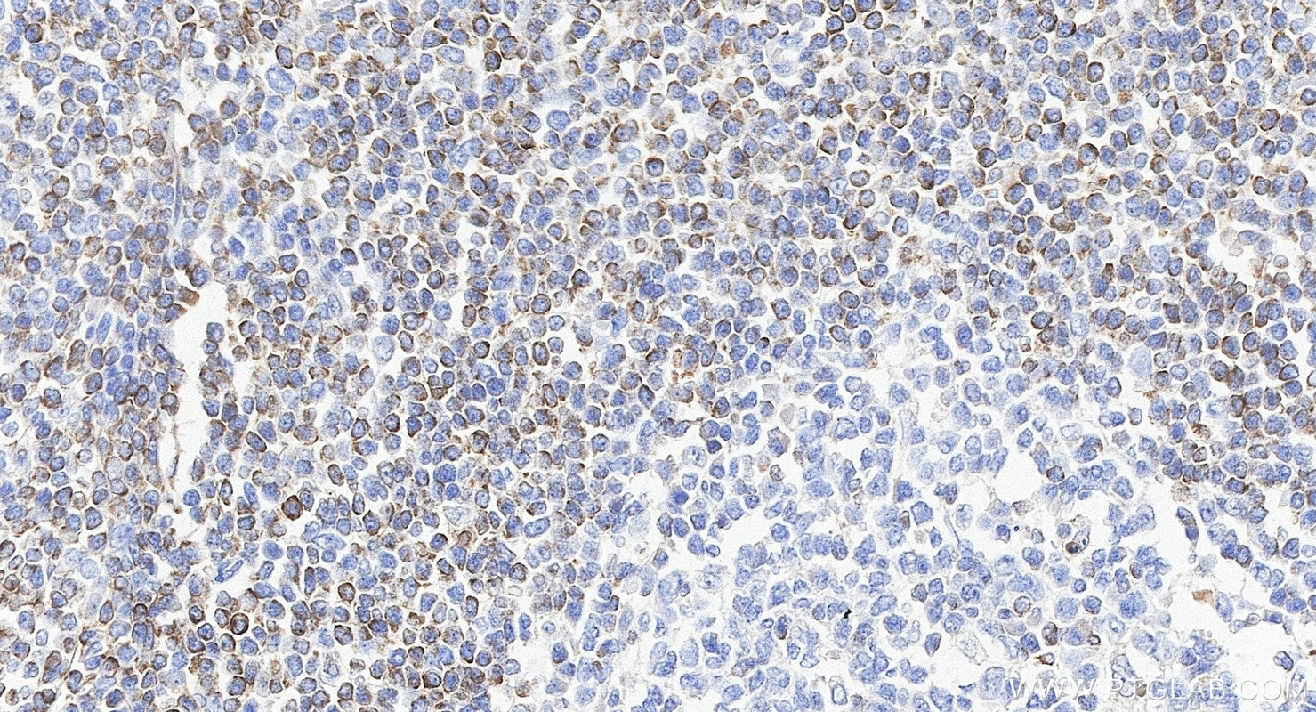 Immunohistochemistry (IHC) staining of human tonsillitis tissue using BCL2 Recombinant monoclonal antibody (80313-1-RR)
