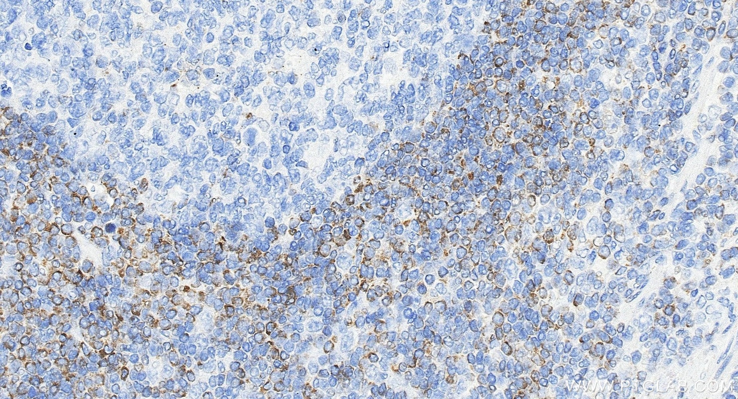 Immunohistochemistry (IHC) staining of human appendicitis tissue using BCL2 Recombinant monoclonal antibody (80313-1-RR)