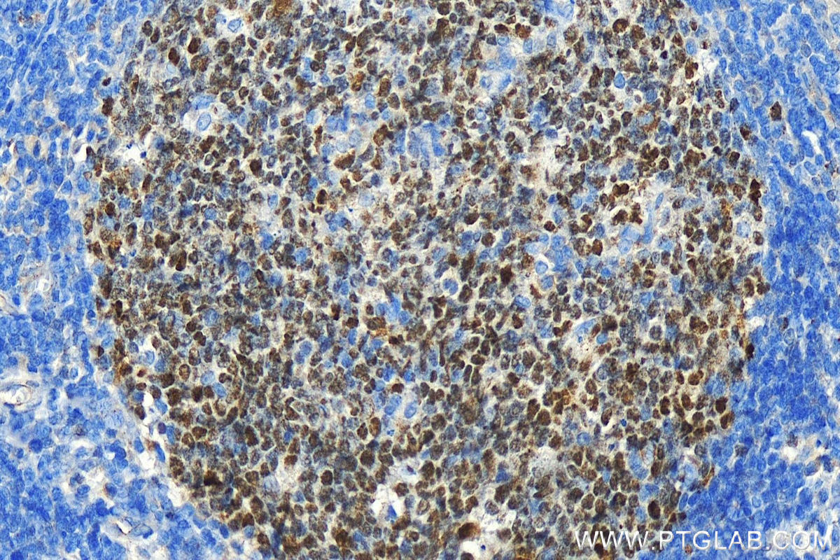 Immunohistochemistry (IHC) staining of human tonsillitis tissue using BCL6 Polyclonal antibody (21187-1-AP)