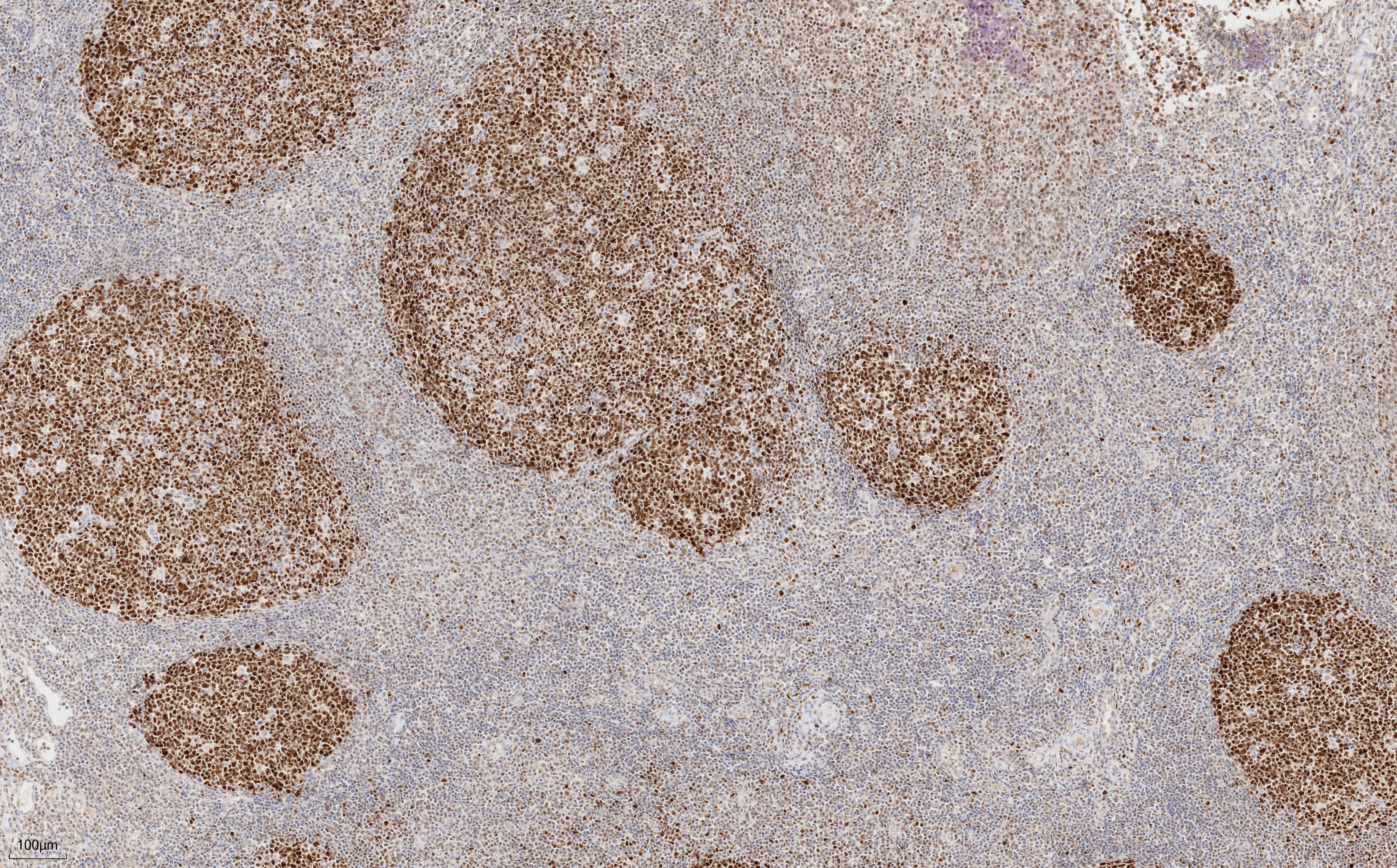 Immunohistochemistry (IHC) staining of human tonsillitis tissue using BCL6 Monoclonal antibody (66340-1-Ig)