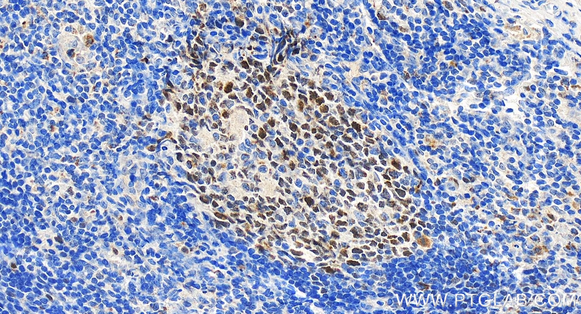 Immunohistochemistry (IHC) staining of human tonsillitis tissue using BCL6 Recombinant antibody (81754-1-RR)