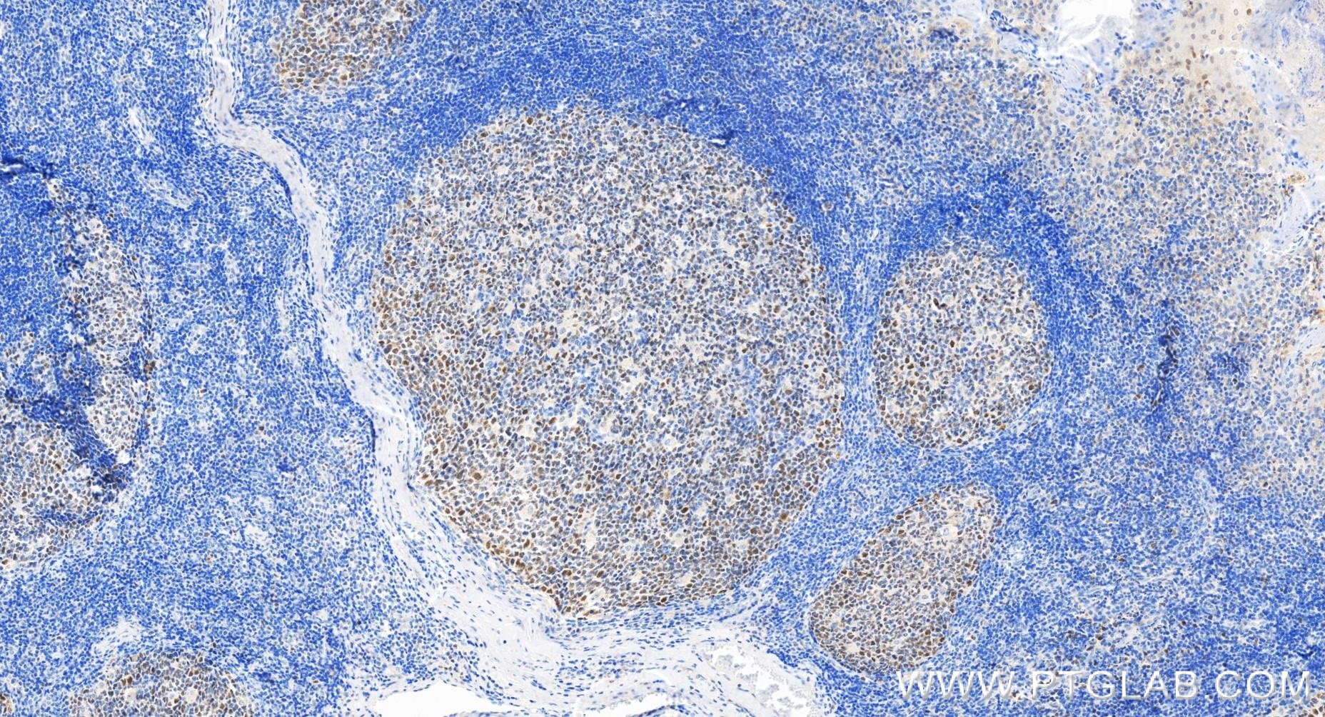 Immunohistochemistry (IHC) staining of human tonsillitis tissue using BCL6 Recombinant antibody (81754-1-RR)