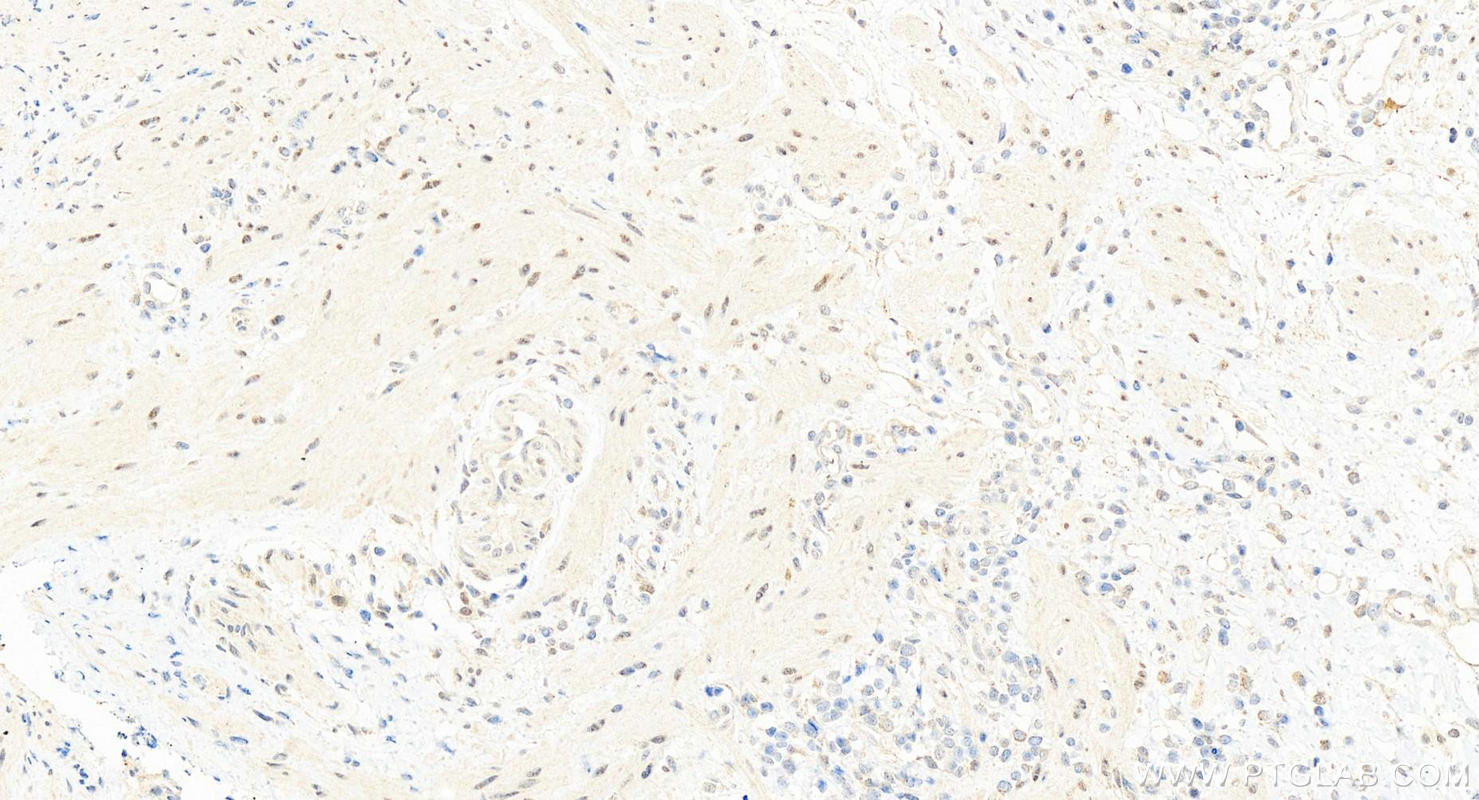 Immunohistochemistry (IHC) staining of human colon cancer tissue using BCL9 Polyclonal antibody (22947-1-AP)