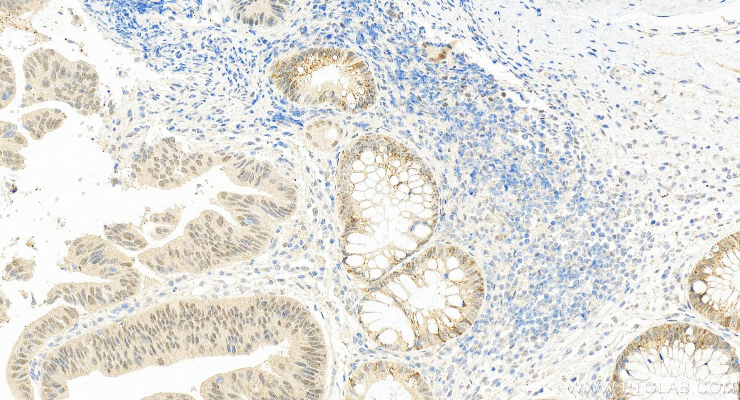 Immunohistochemistry (IHC) staining of human colon cancer tissue using BCL9 Polyclonal antibody (22947-1-AP)