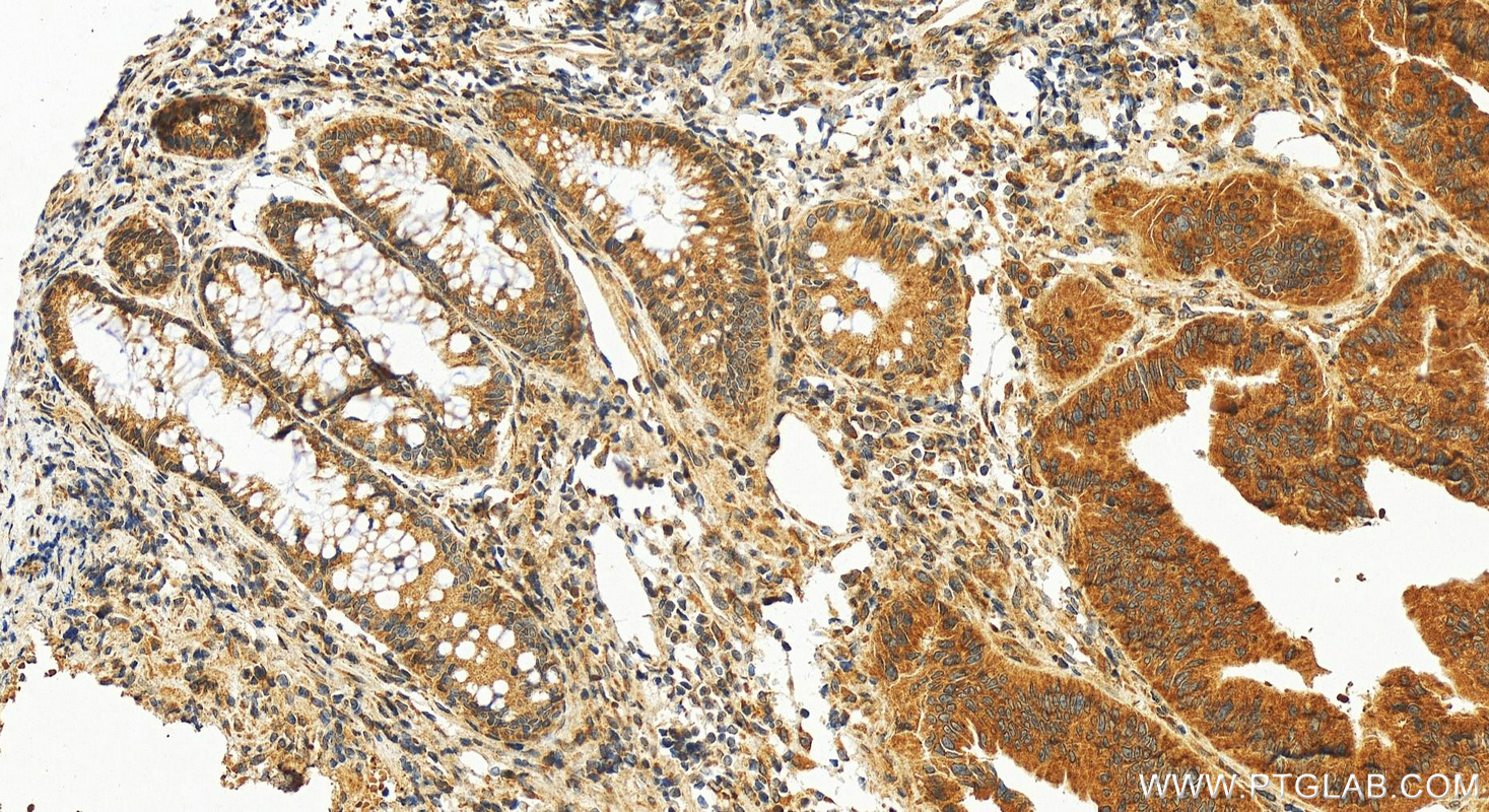 Immunohistochemistry (IHC) staining of human colon cancer tissue using BET1 Polyclonal antibody (11794-1-AP)