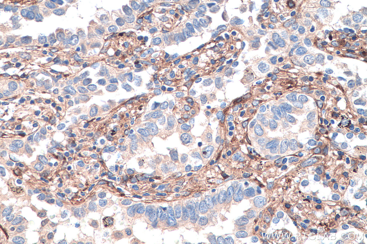 Immunohistochemistry (IHC) staining of human lung cancer tissue using Biglycan Polyclonal antibody (16409-1-AP)