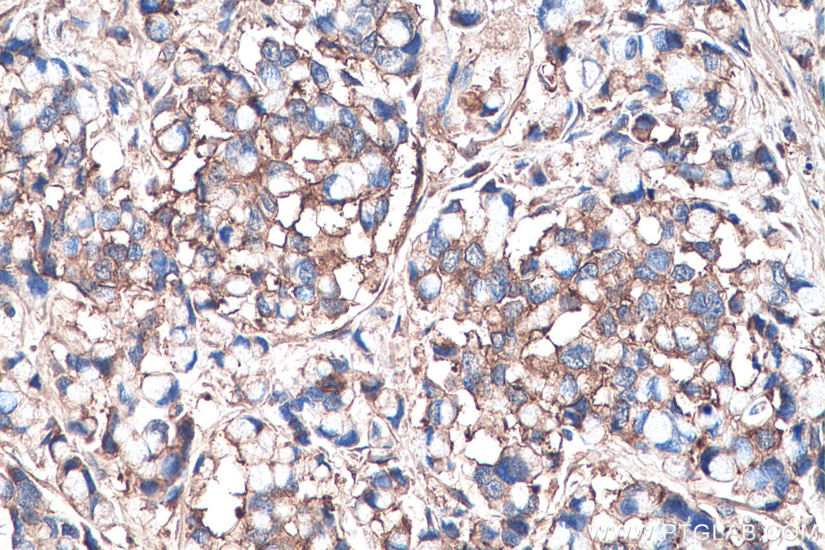 Immunohistochemistry (IHC) staining of human colon cancer tissue using Biglycan Polyclonal antibody (16409-1-AP)