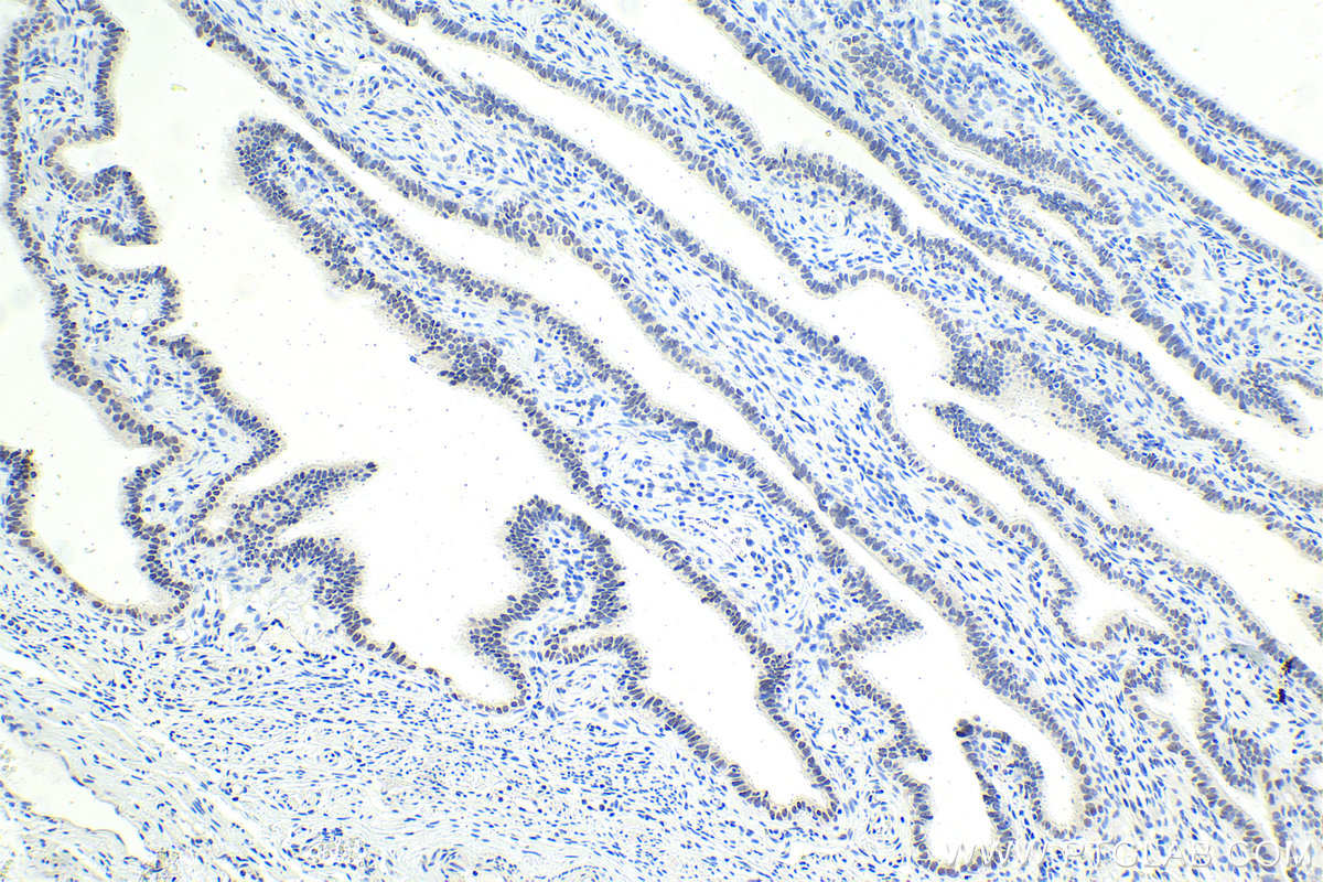 Immunohistochemistry (IHC) staining of human ovary tumor tissue using BHLHE41 Polyclonal antibody (12688-1-AP)