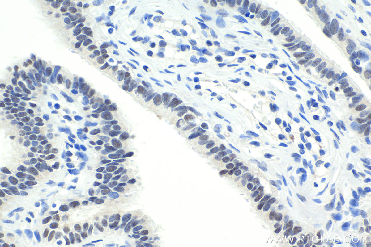 Immunohistochemistry (IHC) staining of human ovary tumor tissue using BHLHE41 Polyclonal antibody (12688-1-AP)