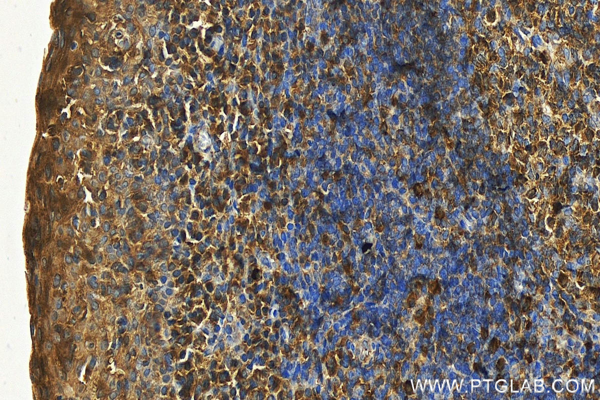 Immunohistochemistry (IHC) staining of human tonsillitis tissue using BLNK Polyclonal antibody (10855-1-AP)