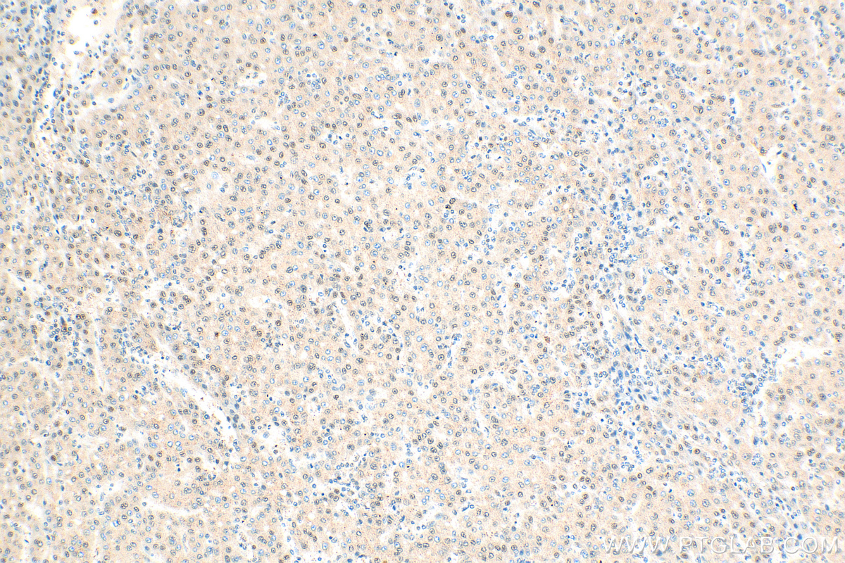 Immunohistochemistry (IHC) staining of human liver cancer tissue using BMI1 Polyclonal antibody (10832-1-AP)