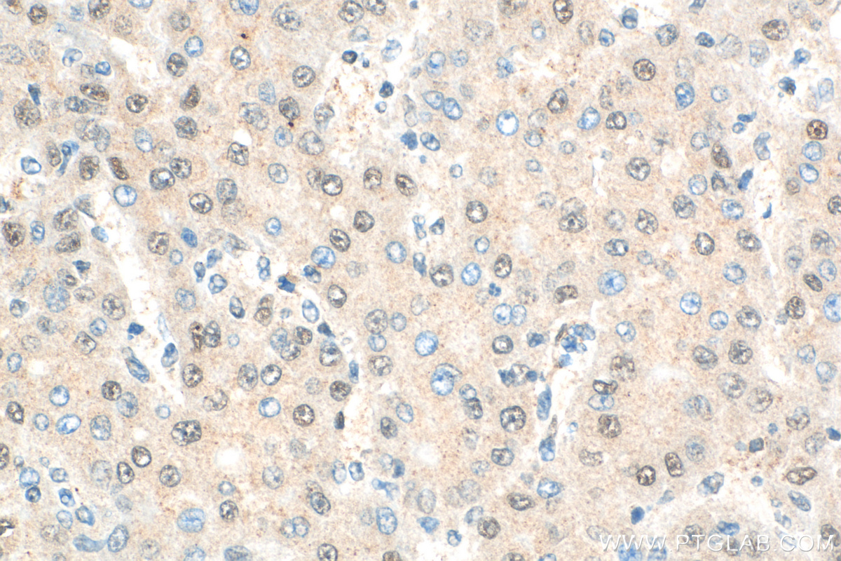 Immunohistochemistry (IHC) staining of human liver cancer tissue using BMI1 Polyclonal antibody (10832-1-AP)