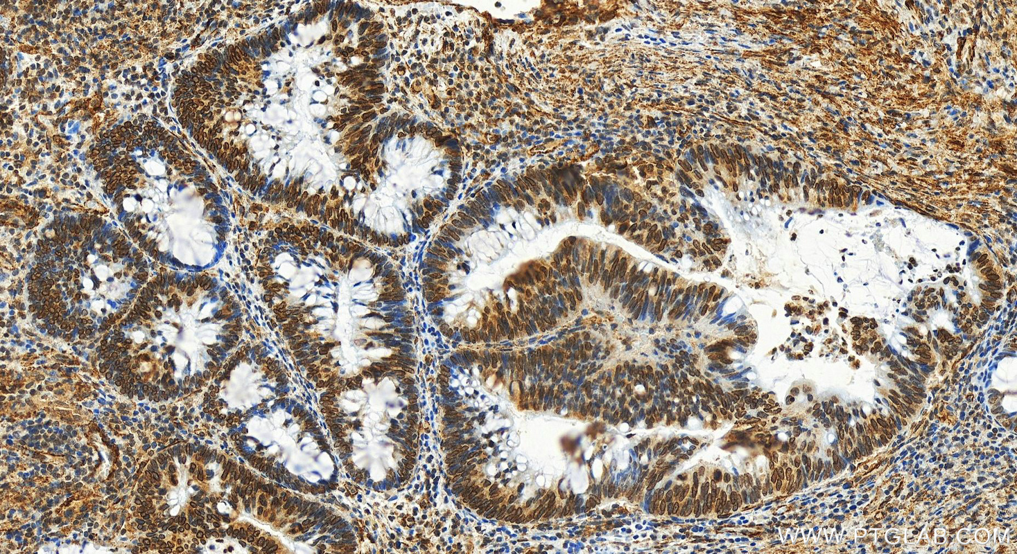 Immunohistochemistry (IHC) staining of human colon  cancer using BMI1 Monoclonal antibody (66161-1-Ig)