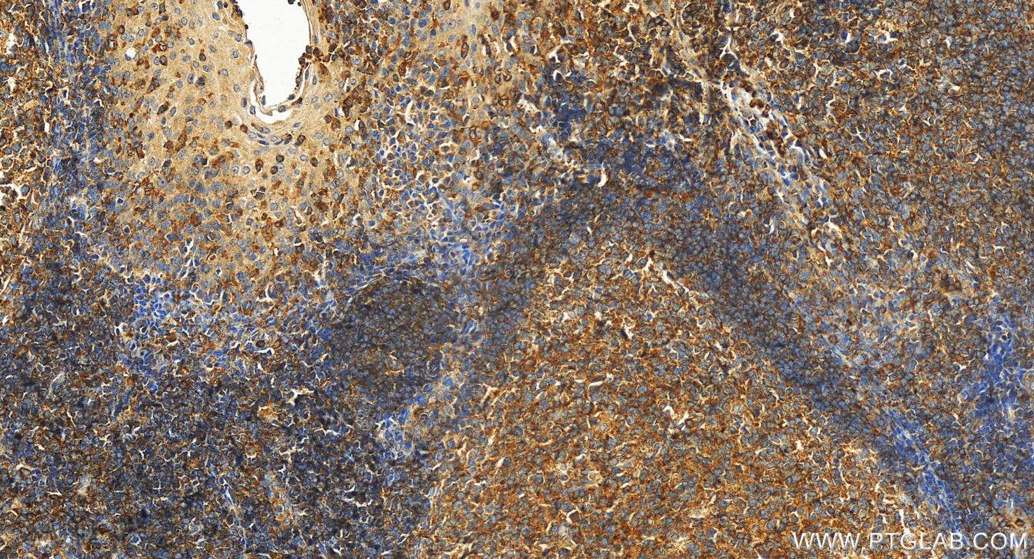 Immunohistochemistry (IHC) staining of human tonsillitis tissue using BMP6 Polyclonal antibody (55421-1-AP)