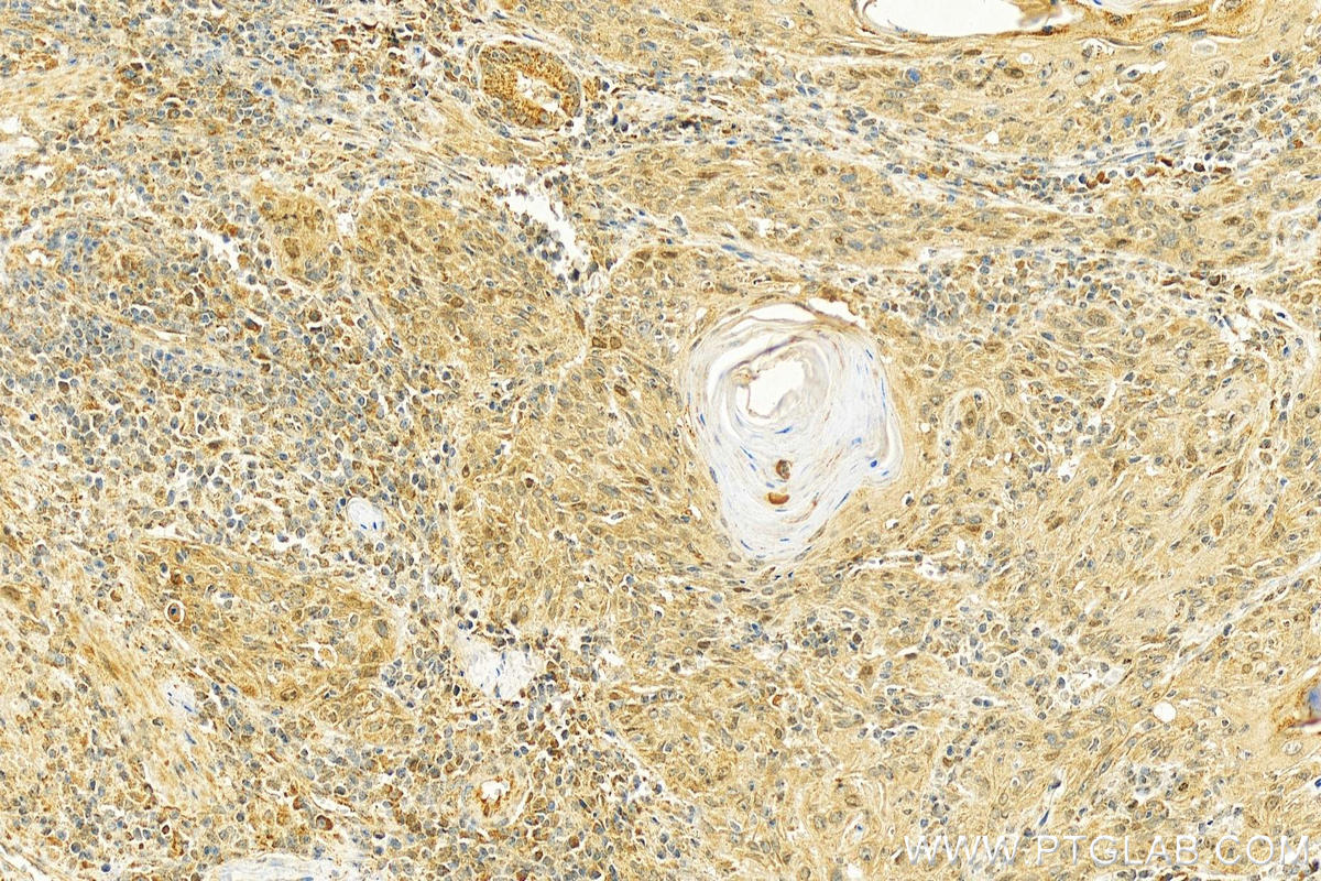 Immunohistochemistry (IHC) staining of human skin cancer tissue using BNIP3L Polyclonal antibody (12986-1-AP)