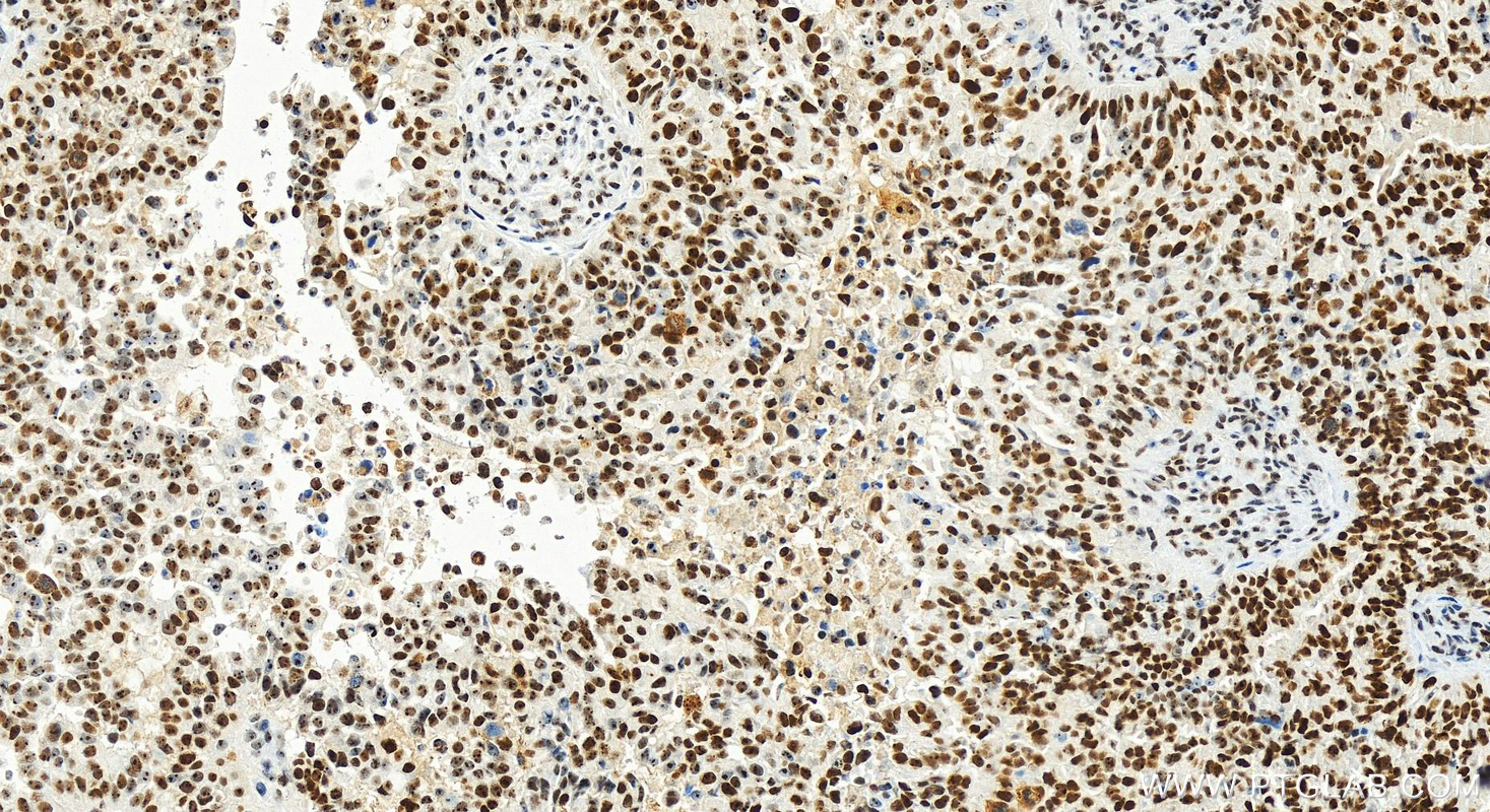 Immunohistochemistry (IHC) staining of human ovarian  cancer using BOP1 Recombinant antibody (82742-3-RR)