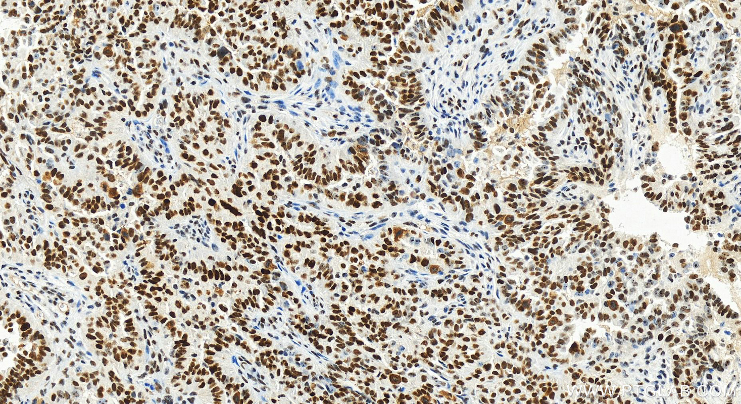 Immunohistochemistry (IHC) staining of human ovarian  cancer using BOP1 Recombinant antibody (82742-3-RR)