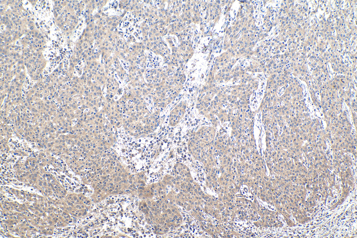 Immunohistochemistry (IHC) staining of human cervical cancer tissue using BORIS Polyclonal antibody (11074-2-AP)