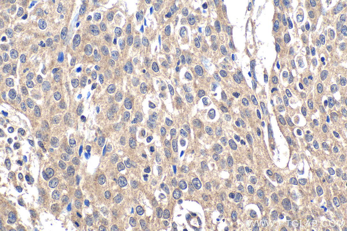 Immunohistochemistry (IHC) staining of human cervical cancer tissue using BORIS Polyclonal antibody (11074-2-AP)