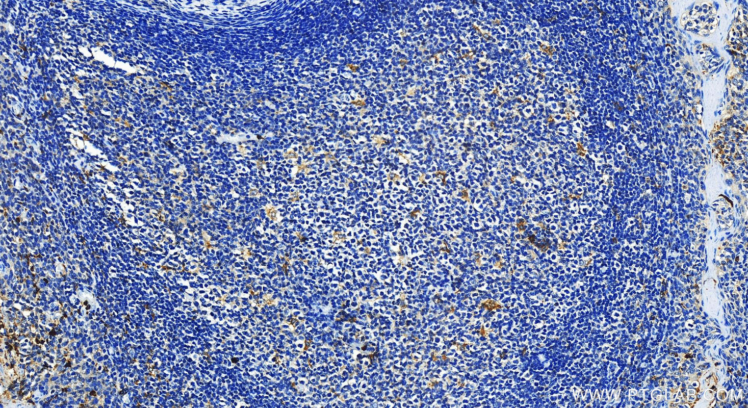 Immunohistochemistry (IHC) staining of human tonsillitis tissue using BPI Polyclonal antibody (14368-1-AP)