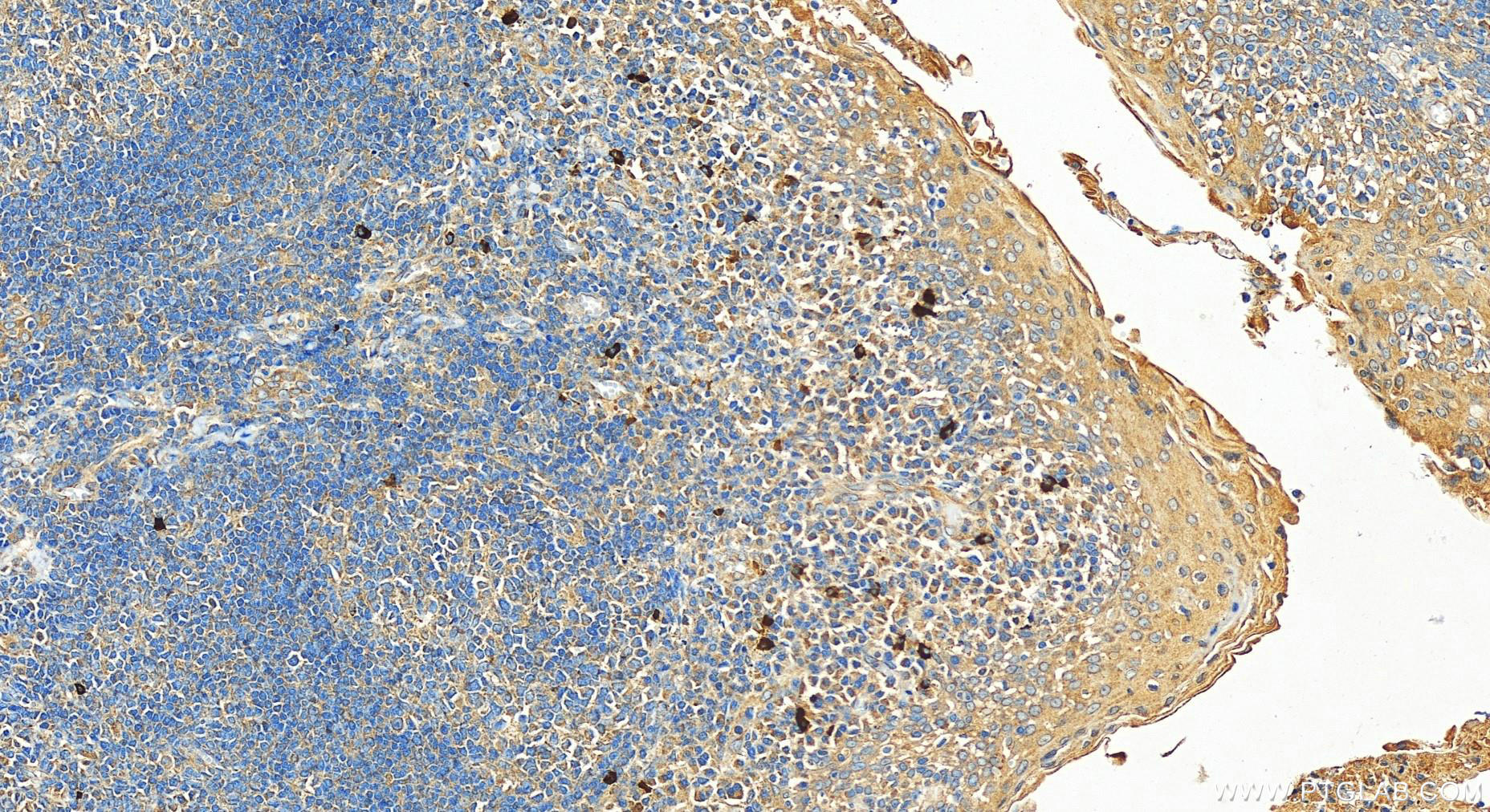 Immunohistochemistry (IHC) staining of human tonsillitis tissue using BPIL1 Polyclonal antibody (13461-2-AP)