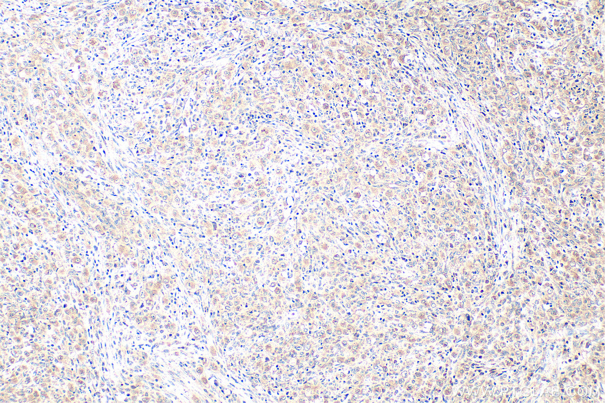 Immunohistochemistry (IHC) staining of human lymphoma tissue using BRAF Polyclonal antibody (20899-1-AP)