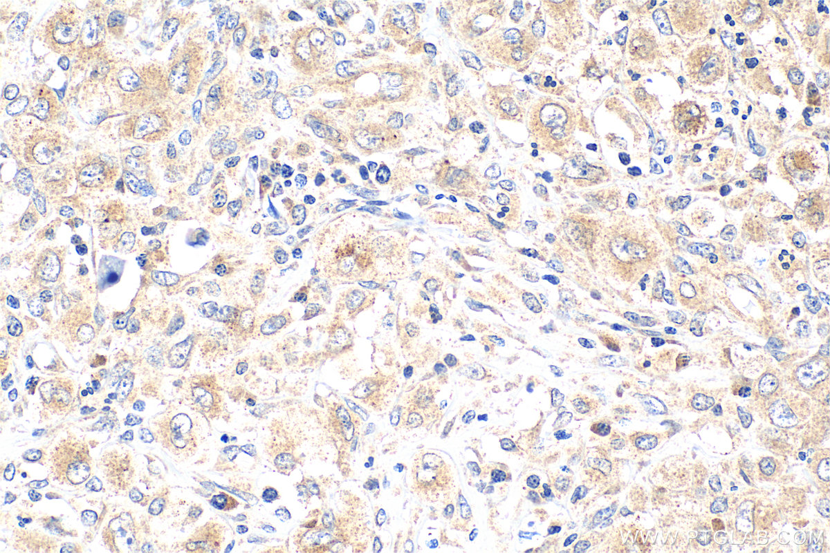 Immunohistochemistry (IHC) staining of human lymphoma tissue using BRAF Polyclonal antibody (20899-1-AP)