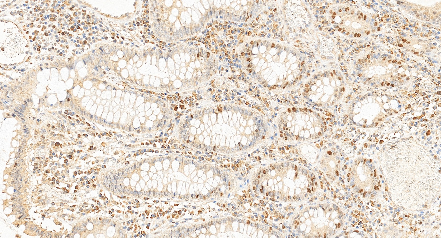 Immunohistochemistry (IHC) staining of human colon cancer tissue using BRCA1 Polyclonal antibody (22362-1-AP)