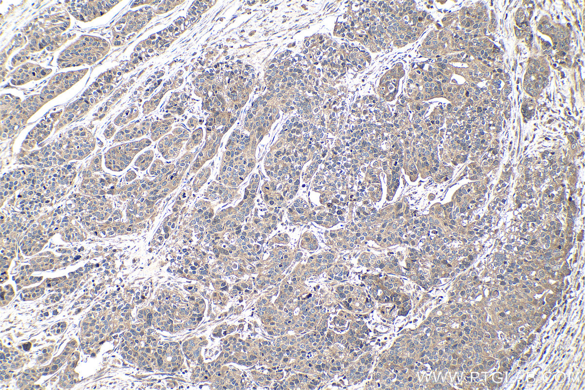 Immunohistochemistry (IHC) staining of human ovary tumor tissue using BRCA1 Polyclonal antibody (22362-1-AP)