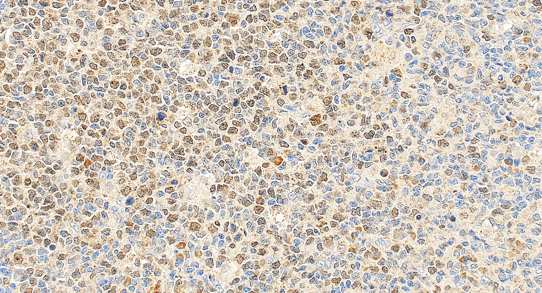 Immunohistochemistry (IHC) staining of human tonsillitis tissue using BRCA1 Polyclonal antibody (22362-1-AP)