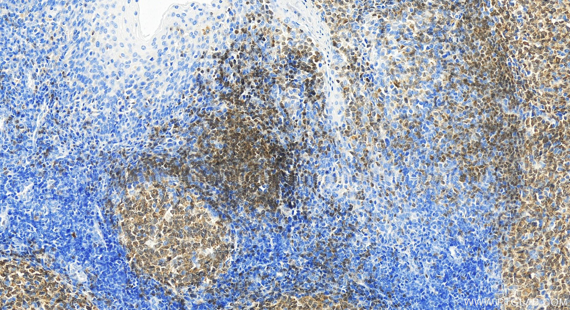 Immunohistochemistry (IHC) staining of human tonsillitis tissue using BSAP,PAX5 Polyclonal antibody (26709-1-AP)