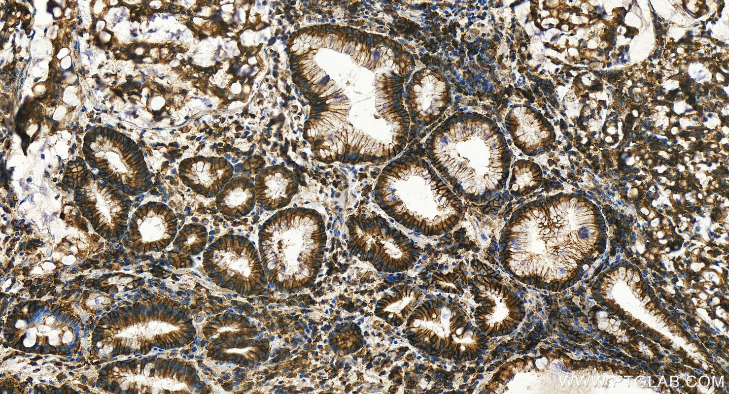 Immunohistochemistry (IHC) staining of human stomach cancer tissue using CD147 Polyclonal antibody (11989-1-AP)