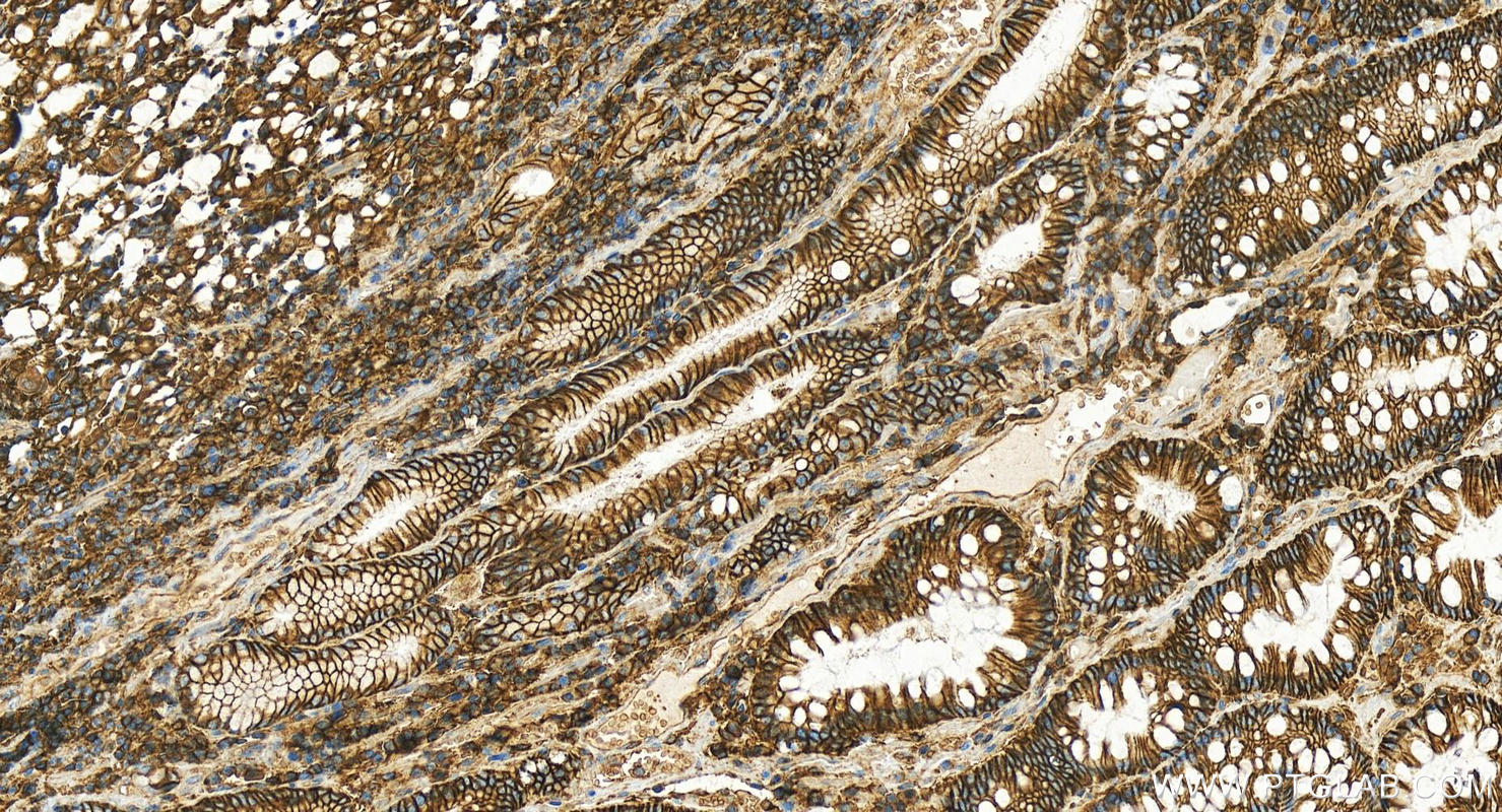 Immunohistochemistry (IHC) staining of human stomach cancer tissue using CD147 Polyclonal antibody (11989-1-AP)