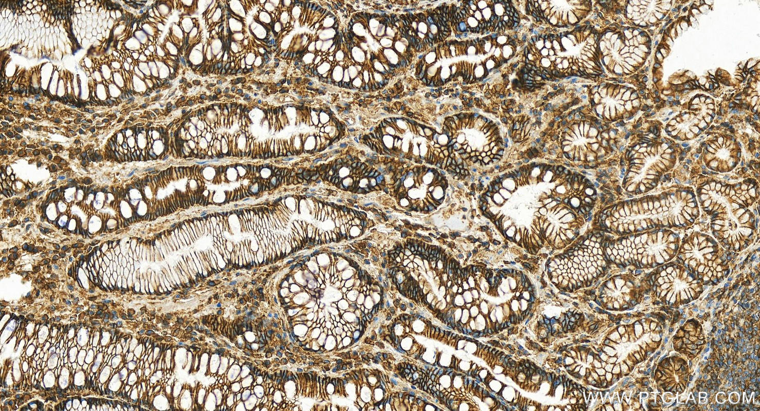 Immunohistochemistry (IHC) staining of human stomach cancer tissue using CD147 Polyclonal antibody (11989-1-AP)