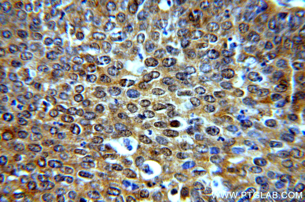 Immunohistochemistry (IHC) staining of human cervical cancer tissue using BTF3L3-Specific Polyclonal antibody (19753-1-AP)