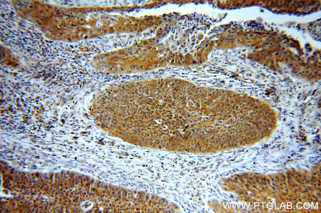 Immunohistochemistry (IHC) staining of human cervical cancer tissue using BTF3L3-Specific Polyclonal antibody (19753-1-AP)