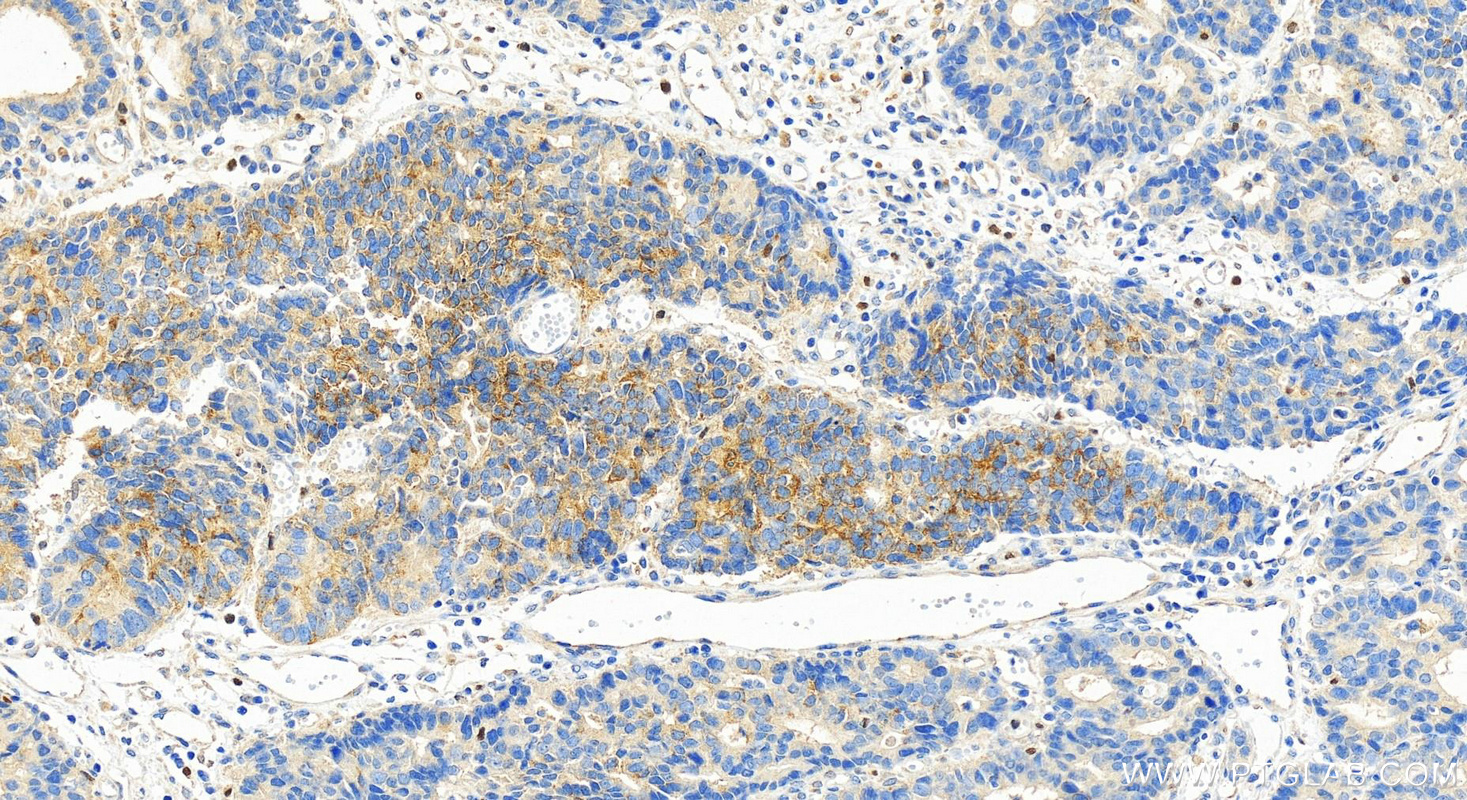 Immunohistochemistry (IHC) staining of human stomach cancer tissue using BTNL8 Polyclonal antibody (24959-1-AP)